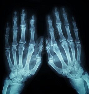 X射线手图片
