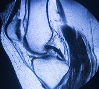 MRI磁共振成像医学扫描测试结果显示膝关节半月板股骨和小腿韧带软骨和人体骨骼背景图片