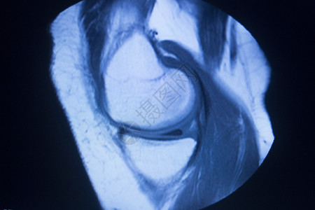 MRI磁共振成像医学扫描测试结果显示膝关节半月板股骨大腿和小腿韧带软骨和人体骨骼背景图片