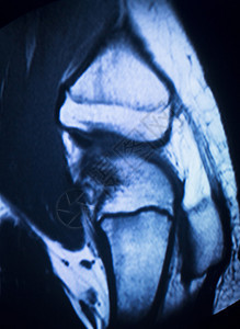 MRI磁共振成像医学扫描测试结果显示膝关节半月板股骨和小腿韧带软骨和人体骨骼背景图片