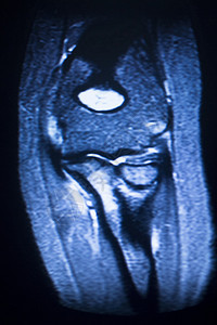 磁共振成像医学扫描测试肘部检查结果显示图片