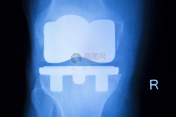 膝关节半月板X射线测试扫描结果照片显示损伤和疼痛以及整形外科和创伤外科图片