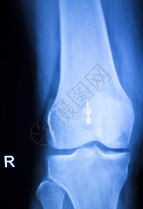 膝关节半月板X射线测试扫描结果照片显示损伤和疼痛以及整形外科和创伤外科背景图片