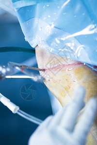 整形膝部手术创伤医院的外科手术图片