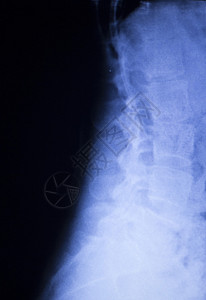 脊椎背部疼痛和颈部整形X光图片