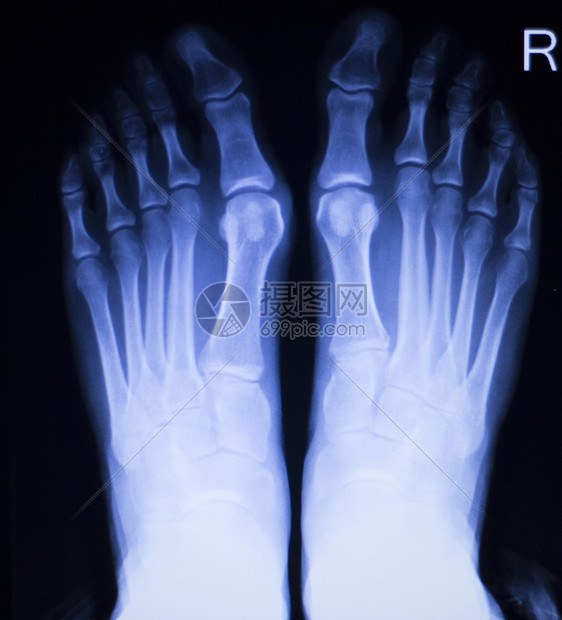 脚部和脚趾受伤创伤医疗X射线整形图片