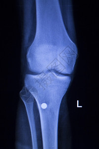 Knee和meniscus受伤医学X射线检查扫描结果显示整形创伤钛图片