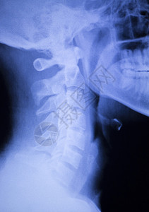 脊椎背部疼痛和颈部整形X光图片
