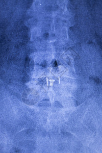 脊柱背部和颈部整形钛金属脊椎板图片