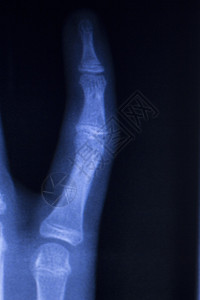 手和指受伤整形创伤医学X射线图片
