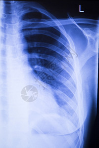 肩部联合受伤X射线创伤学和整形检查用于诊断病人运动伤害的医疗扫描背景图片