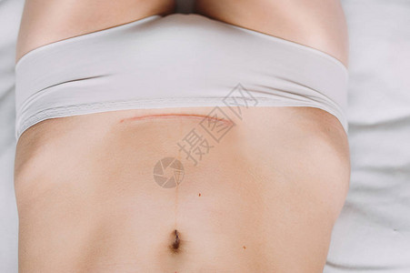女人的肚子塞满从剖宫产瘢痕的特写图片