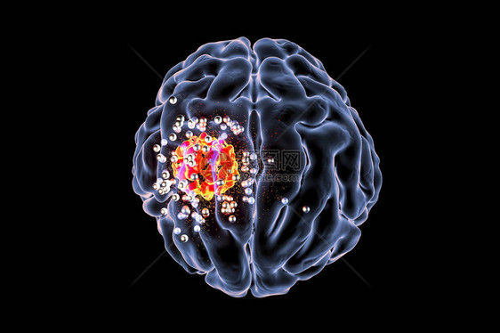 纳米粒子对脑肿瘤的破坏图片