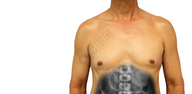 结肠癌和小肠梗阻人的腹部用X射线显示由于阻塞而扩张的小肠孤立的背景左图片