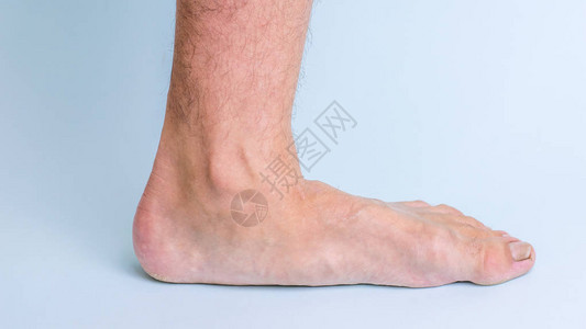 有关节疾病和扁平脚症状的人的左腿腿部和关节疾病图片