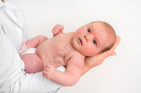 有皮疹的新生儿出生后过敏反应身体试图解毒图片