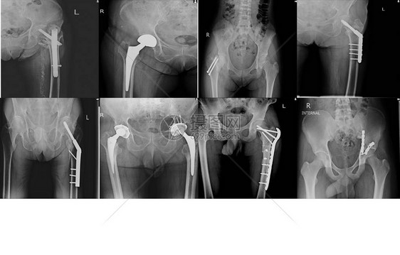 X线采集骨科手术多髋关节手术和钢板内固定和螺钉内固定图片