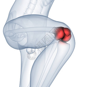 人体骨联合疼痛膝合症3图片
