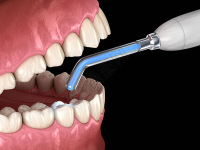 用填充和聚合灯修复牙类医学上准确的牙图片