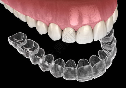 外观牙套或隐形保留人医学上准确的图片