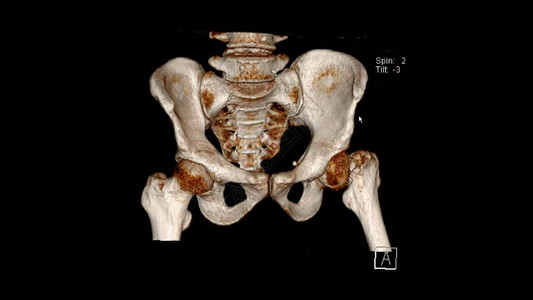对显示左股骨颈折CTVRPelvis的骨盆进行心图片