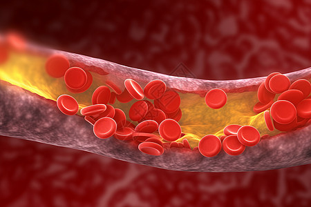 动脉中的胆固醇斑块医学概念3d效果图设计图片