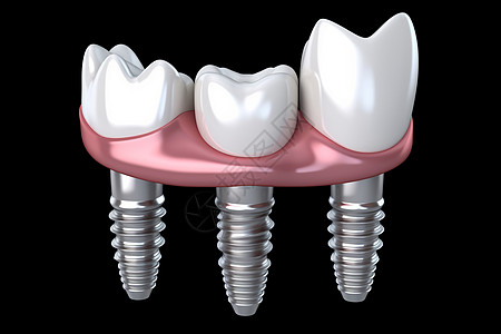 种植牙背景图片
