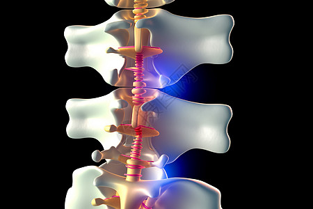 腰椎间盘突出症椎间盘的3D模型设计图片