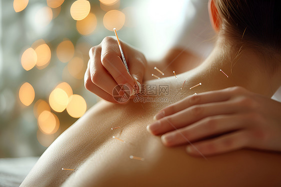 一名女性正在接受针灸图片