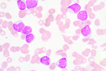 淋巴细胞增多照片