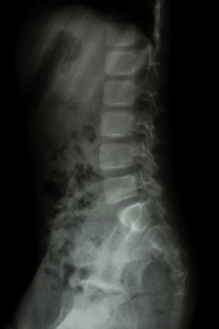 孩子 x 射线胸腰段脊柱 腰椎 野火