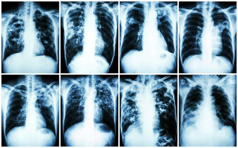 肺结核的集合。胸部 x 线 显示片状浸润，间质浸润，肺泡浸润 腔，纤维化肺由于结核杆菌感染