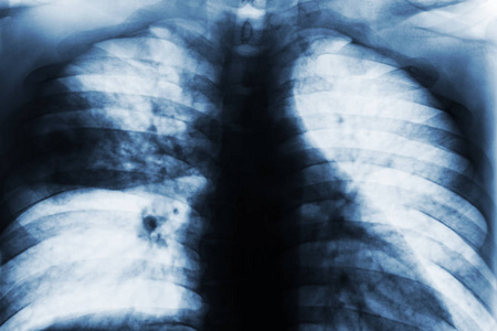 大叶性肺炎。 胶片胸部X线显示在钻机上有斑片状浸润