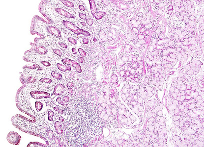 组织学的人体组织，显示胃粘膜肠上皮化生，如在显微镜下观察
