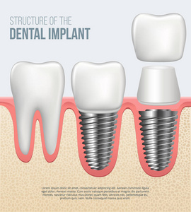 现实的健康牙和牙种植体