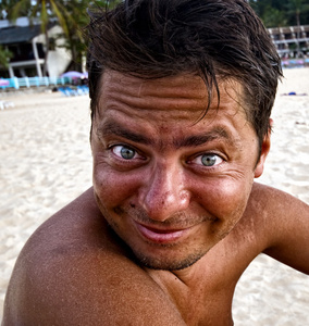 年幼的女人和红色的晒黑的皮向她背强烈晒伤抽象太阳人体皮肤层损坏从