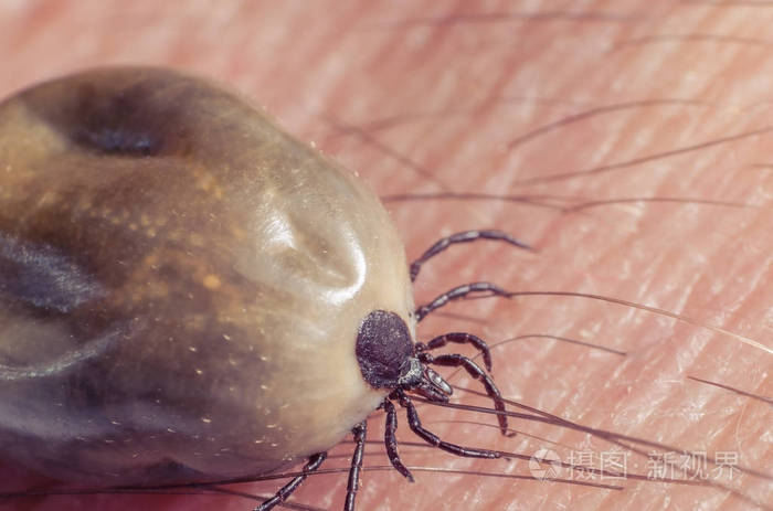 满腔热血坐在人体皮肤上的蜱虫