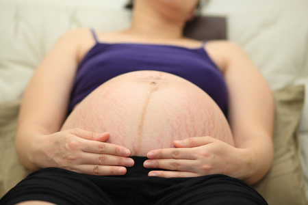 皮肤皴裂的孕妇肚子的特写图片