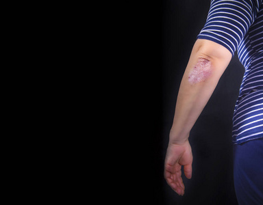 湿疹和其他皮肤干燥条件医生与银屑病标志银屑病在平板电脑上的标志