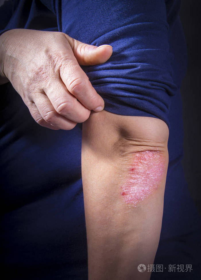 肘部银屑病