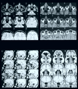 核磁共振图片图片