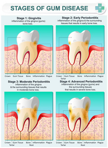 牙龈疾病的阶段图片