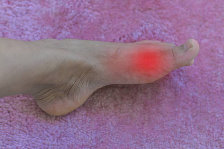 患风湿性关节炎疼痛痛苦和发炎痛风由痛苦痛风炎症引起的变形的大脚趾