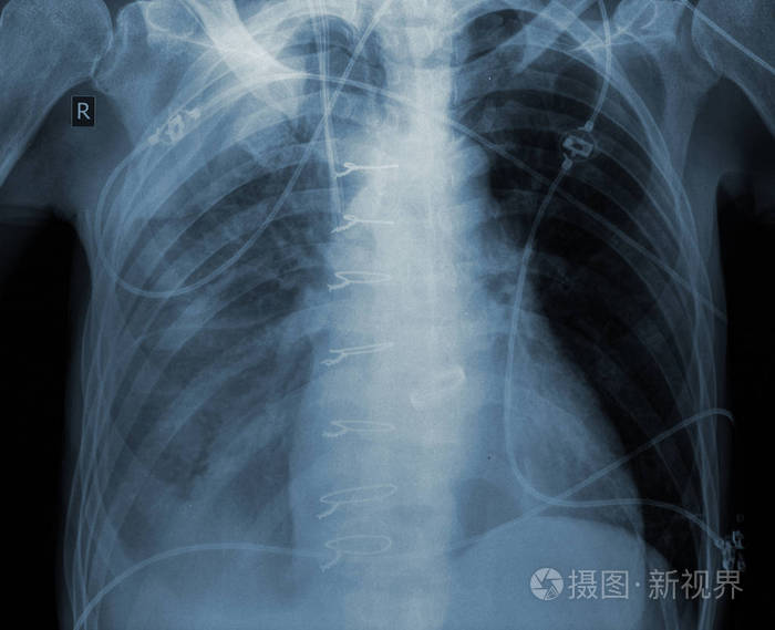 心脏手术后病人的x光检查