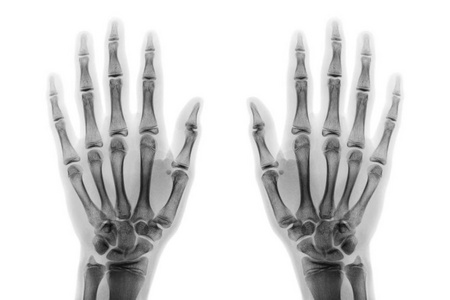 脊柱 肋骨 射线 人类 胸部计数 3手和手臂的骨头人体关节疼痛胸部