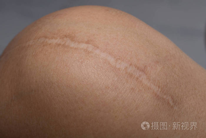 瘢痕疙瘩皮肤身体特写图像上