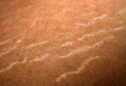 橘皮组织免费图片