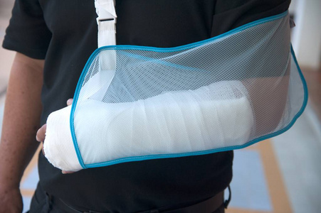 因为胳膊折了,男人用灰泥照片