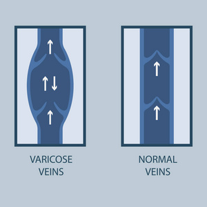 曲张静脉和正常静脉矢量插图