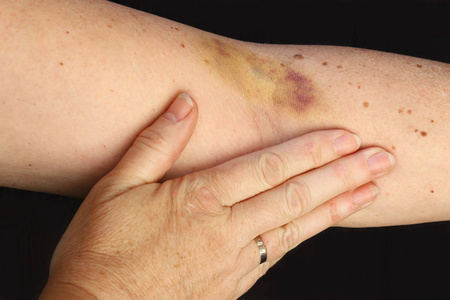 女性胳膊一个女人的胳膊上的血肿照片